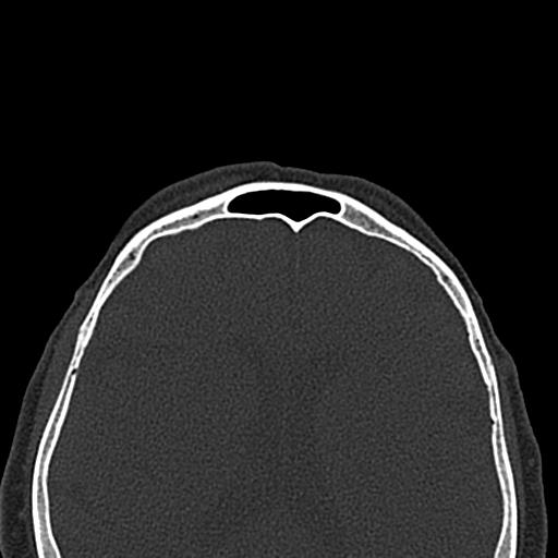 Antral exostoses (Radiopaedia 22371-22396 Axial bone window 49).jpg