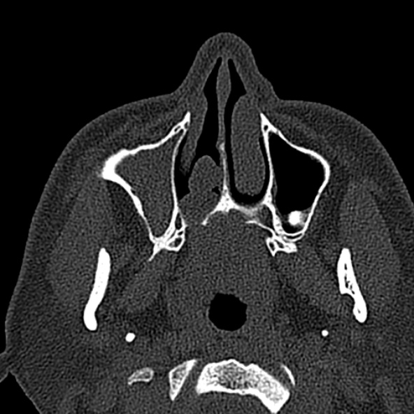 Antrochoanal polyp (Radiopaedia 30002-30554 Axial bone window 16).jpg