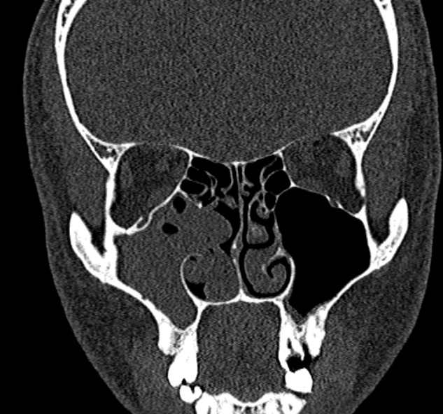 Antrochoanal polyp (Radiopaedia 30002-30554 Coronal bone window 39).jpg