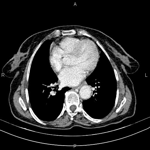 Aortic aneurysm and Lemmel syndrome (Radiopaedia 86499-102554 A 1).jpg