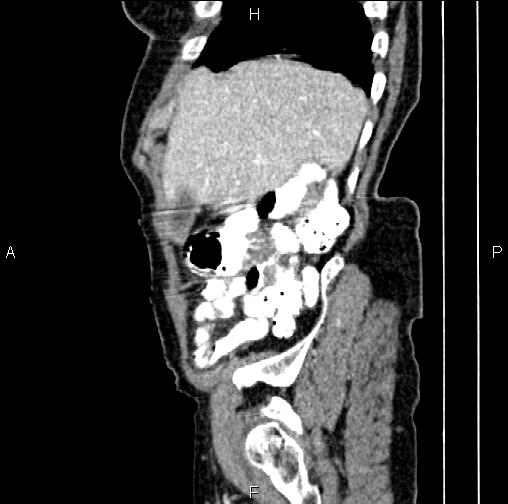 File:Aortic aneurysm and Lemmel syndrome (Radiopaedia 86499-102554 D 13).jpg