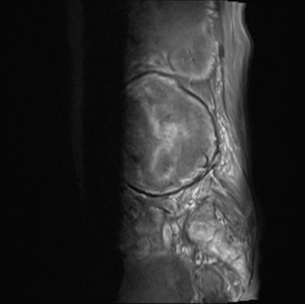 File:Aortic aneurysm with spinal destruction (Radiopaedia 42301-45409 Sagittal T1 fat sat 16).jpg