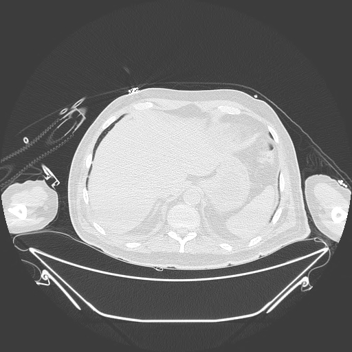 Aortic arch aneurysm (Radiopaedia 84109-99365 Axial lung window 244).jpg