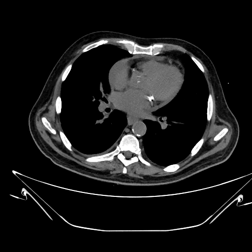 Aortic arch aneurysm (Radiopaedia 84109-99365 Axial non-contrast 158).jpg