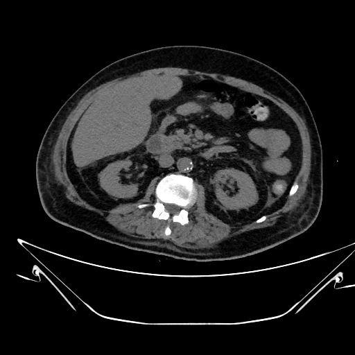 Aortic arch aneurysm (Radiopaedia 84109-99365 Axial non-contrast 338).jpg