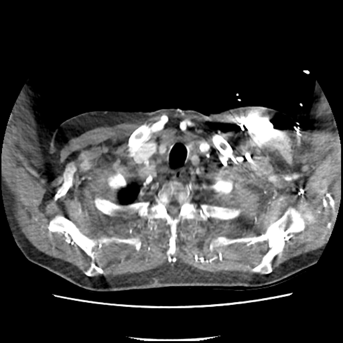 Aortic arch graft infection (FDG PET-CT) (Radiopaedia 71975-82437 A 2).jpg