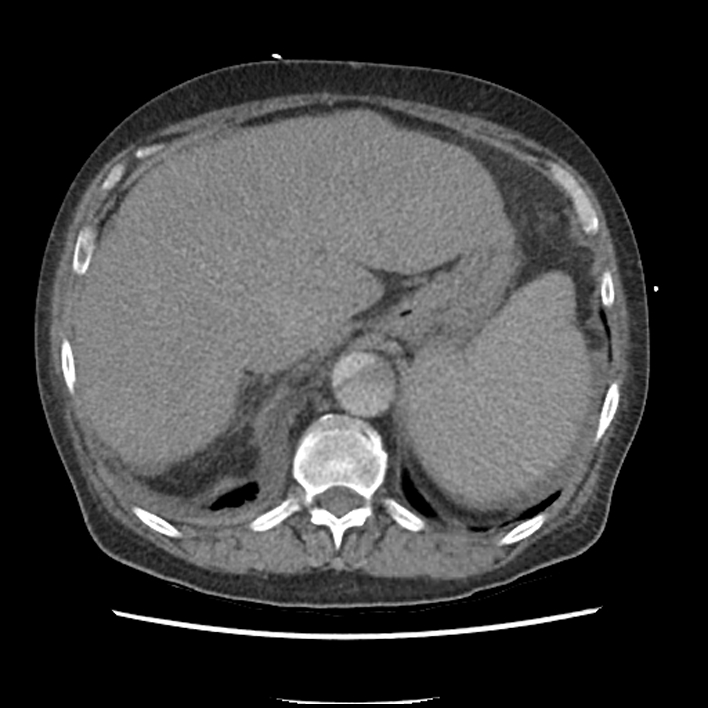 Aortic arch graft infection (FDG PET-CT) (Radiopaedia 71975-82437 A 58).jpg