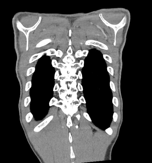 Aortic coarctation with aneurysm (Radiopaedia 74818-85828 C 105).jpg