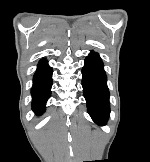 Aortic coarctation with aneurysm (Radiopaedia 74818-85828 C 106).jpg