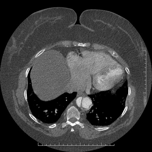 Aortic dissection- Stanford A (Radiopaedia 35729-37268 B 8).jpg