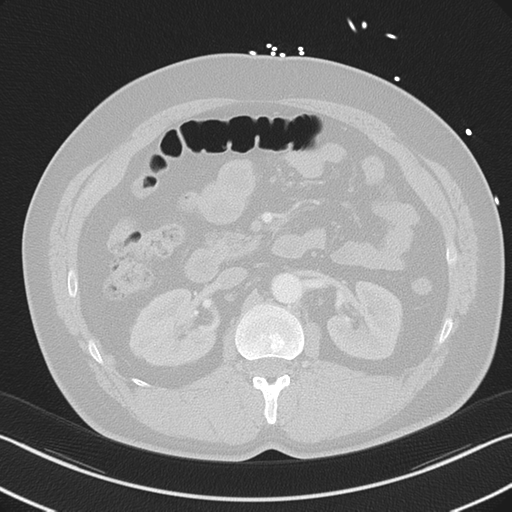 File:Aortic dissection (Radiopaedia 50763-56234 Axial lung window 76).png
