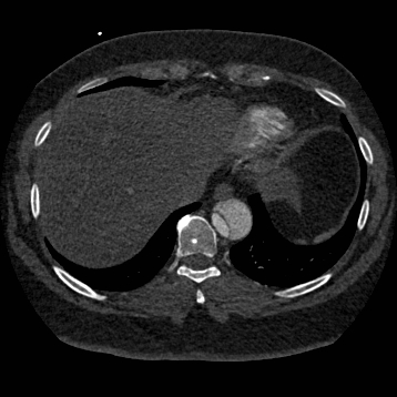 Aortic dissection (Radiopaedia 57969-64959 A 246).jpg