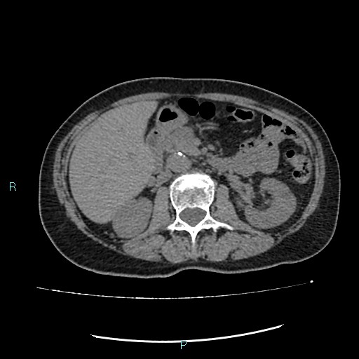 File:Aortic dissection extended to lusory artery (Radiopaedia 43686-47136 Axial non-contrast 34).jpg