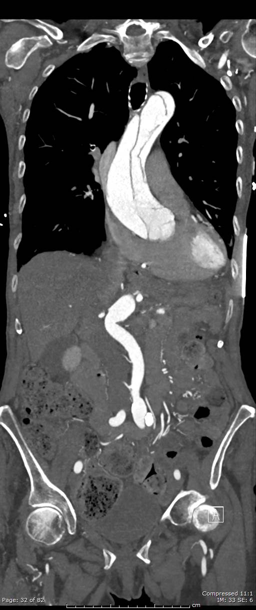 Aortic dissection with extension into aortic arch branches (Radiopaedia 64402-73204 A 32).jpg