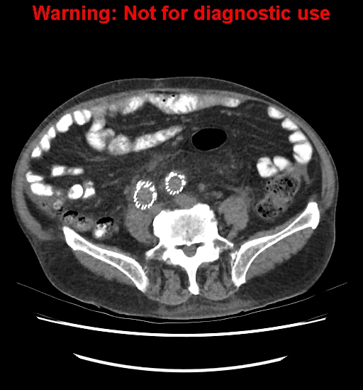 Aortic graft infection (Radiopaedia 44979-48907 Axial non-contrast 63).jpg