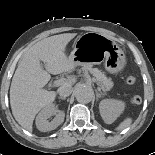 File:Aortic intramural hematoma (Radiopaedia 31139-31838 Axial non-contrast 54).jpg