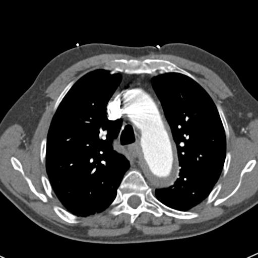 File:Aortic intramural hematoma (Radiopaedia 31139-31838 B 30).jpg