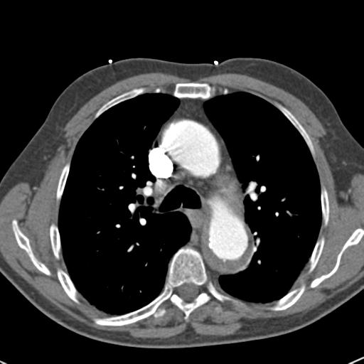 Aortic intramural hematoma (Radiopaedia 31139-31838 B 34).jpg