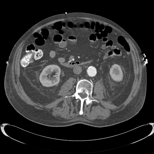 Aortic intramural hematoma (Radiopaedia 34260-35540 B 58).png