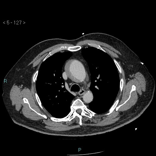 Aortic intramural hematoma (Radiopaedia 48463-53380 C 57).jpg