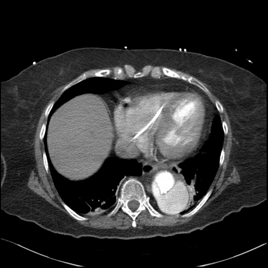 File:Aortic intramural hematoma with dissection and intramural blood pool (Radiopaedia 77373-89491 B 83).jpg