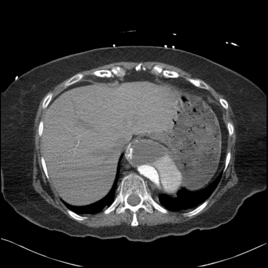Aortic intramural hematoma with dissection and intramural blood pool (Radiopaedia 77373-89491 B 94).jpg