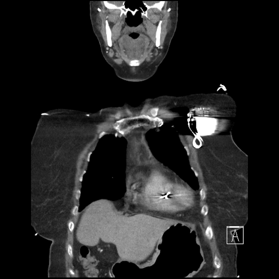 Aortic intramural hematoma with dissection and intramural blood pool (Radiopaedia 77373-89491 C 10).jpg