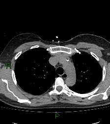 Aortic valve endocarditis (Radiopaedia 87209-103485 Axial non-contrast 30).jpg
