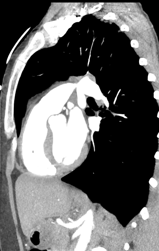 Aortic valve non-coronary cusp thrombus (Radiopaedia 55661-62189 C+ arterial phase 22).png