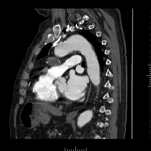 File:Aorto-coronary bypass graft aneurysms (Radiopaedia 40562-43157 C 23).png