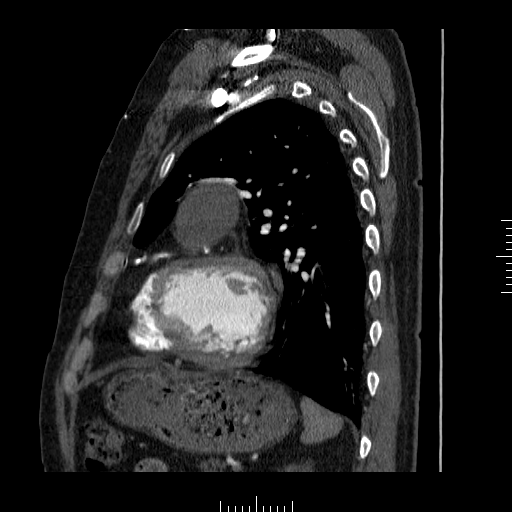 File:Aorto-coronary bypass graft aneurysms (Radiopaedia 40562-43157 C 31).png
