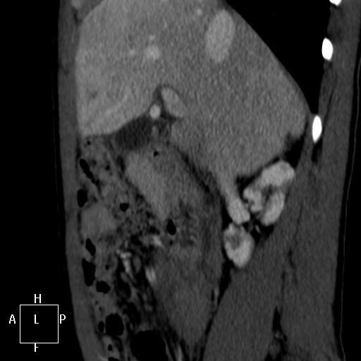 Aorto-left renal vein fistula (Radiopaedia 45534-49628 C 9).jpg