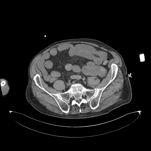 Aortoduodenal fistula (Radiopaedia 75286-86415 Axial non-contrast 52).jpg