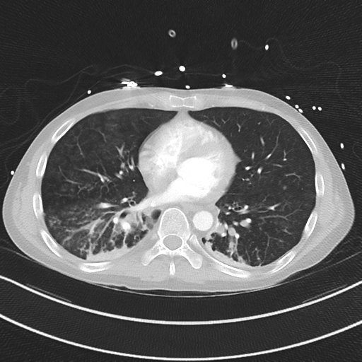 Apical bullous disease in a heavy smoker (Radiopaedia 33067-34092 Axial lung window 40).png