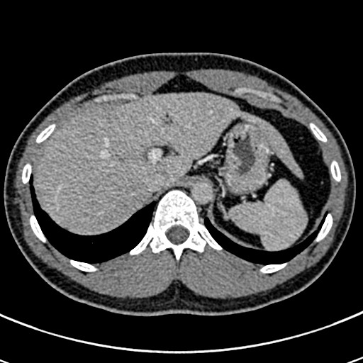 Apical lung mass mimic - neurogenic tumor (Radiopaedia 59918-67521 A 78).jpg
