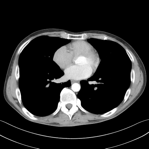 File:Apical pleural calcification (Radiopaedia 46141-50499 Axial C+ delayed 42).png
