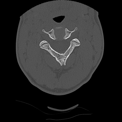 File:Apical pneumothorax on cervical spine CT (Radiopaedia 45343-49368 Axial bone window 29).jpg