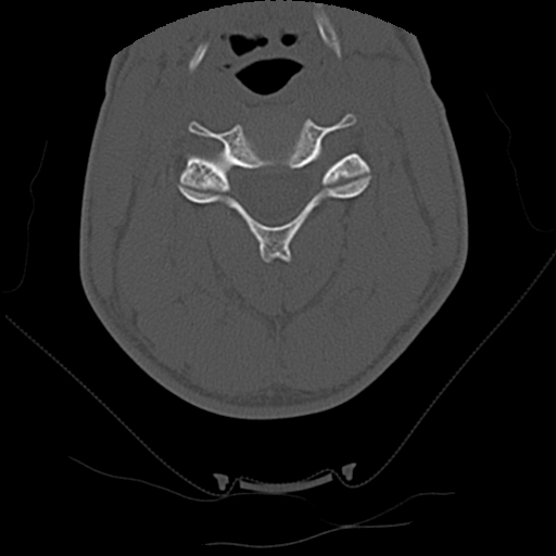 Apical pneumothorax on cervical spine CT (Radiopaedia 45343-49368 Axial bone window 39).jpg