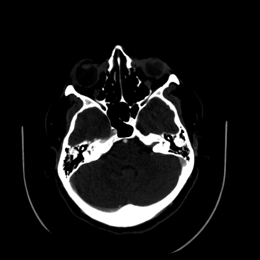 File:Aplasia of the internal carotid artery (Radiopaedia 61082-68960 A 19).jpg