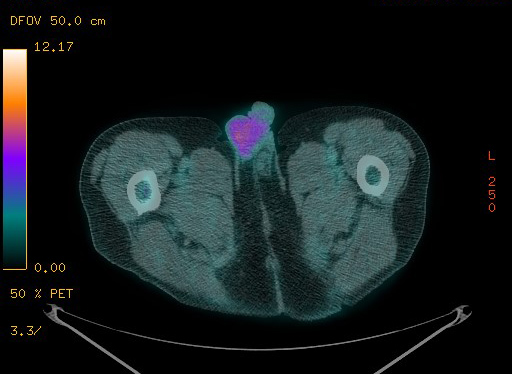 Appendiceal adenocarcinoma complicated by retroperitoneal abscess (Radiopaedia 58007-65041 Axial PET-CT 208).jpg