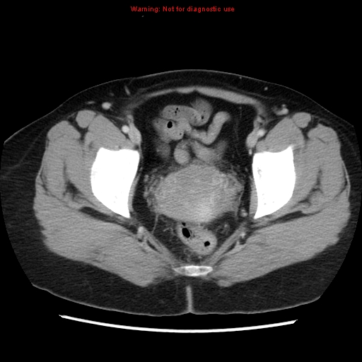 Appendiceal mucinous cystadenoma (Radiopaedia 8263-9111 Axial liver window 74).jpg