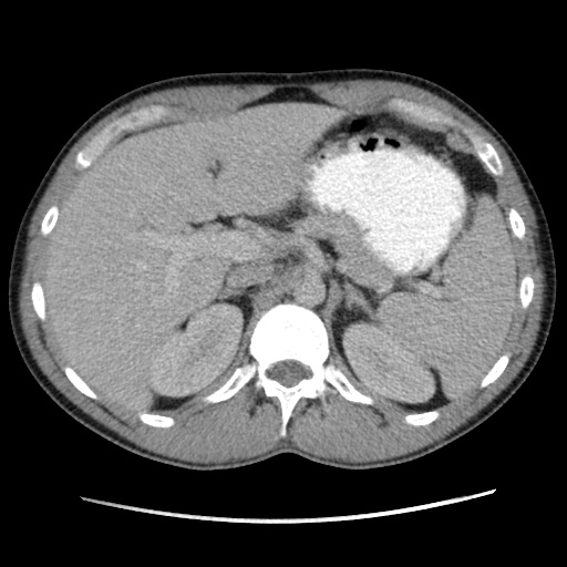 Appendicitis complicated by post-operative collection (Radiopaedia 35595-37114 A 24).jpg