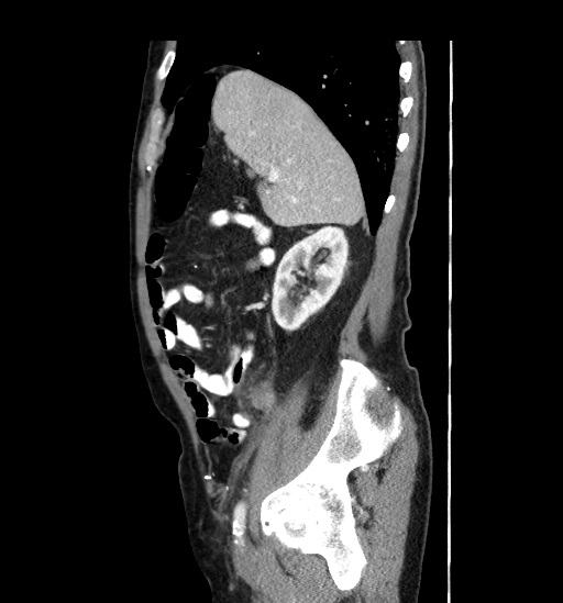 Appendicitis with localized perforation and abscess formation (Radiopaedia 49035-54130 C 18).jpg