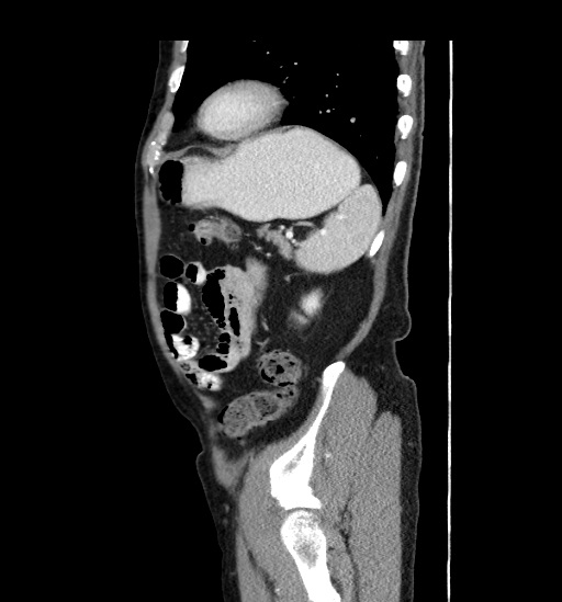 Appendicitis with localized perforation and abscess formation (Radiopaedia 49035-54130 C 52).jpg