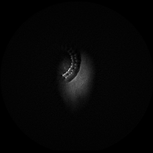 File:Aqueduct stenosis due to web (Radiopaedia 42207-45273 Axial FLAIR 26).png