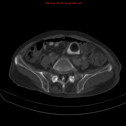 File:Arachnoiditis ossificans (Radiopaedia 51394-57136 Axial bone window 30).jpg