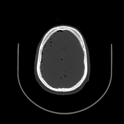Arrow injury to the brain (Radiopaedia 72101-82607 Axial bone window 84).jpg