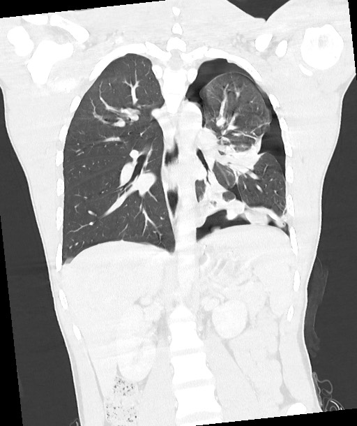 Arrow injury to the chest (Radiopaedia 85367-100975 Coronal lung window 84).jpg