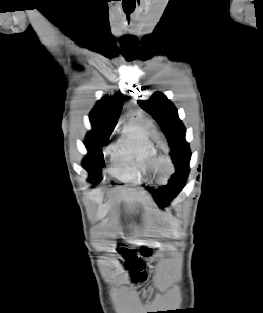 Arrow injury to the chest (Radiopaedia 85367-100975 F 44).jpg