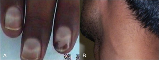 (A) Arsenic neuropathy and Mee's line (B) great auricular nerve thickening